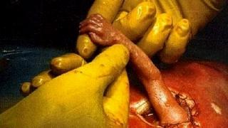 Фото малыша, прооперированного в утробе матери в 1999 году